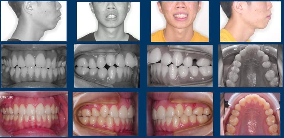 青少年數位隱形矯正、拔牙矯正，臨床案例
