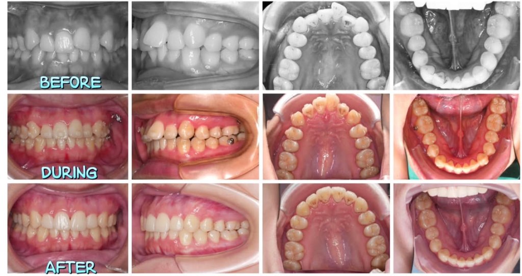 使用隱形牙套改善前牙不整齊