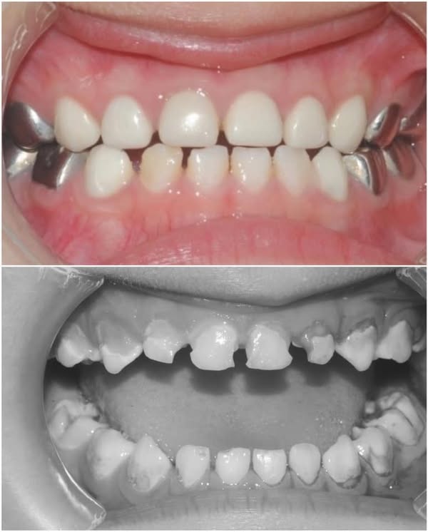 乳牙二氧化鋯牙冠