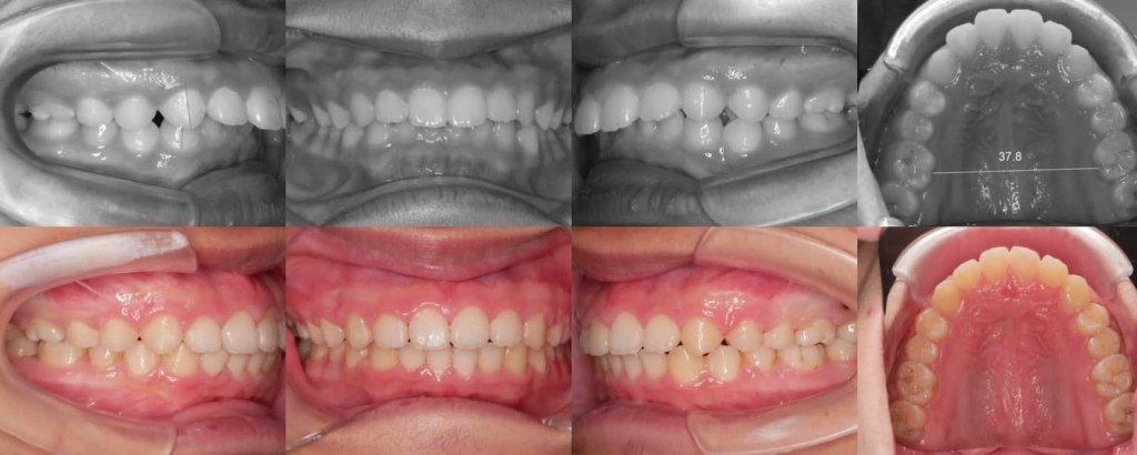 門牙前突，不拔牙案例