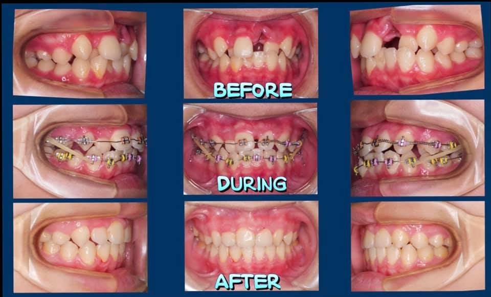 青少年傳統矯正，臨床案例