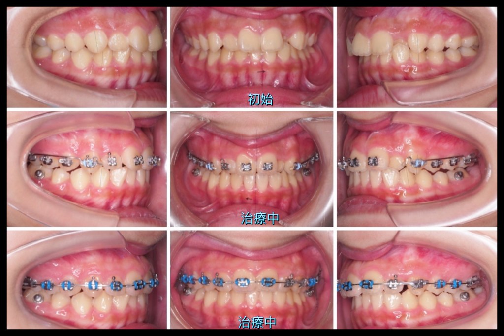 青少年第二類咬合 利用CAM原理加速矯正治療案例