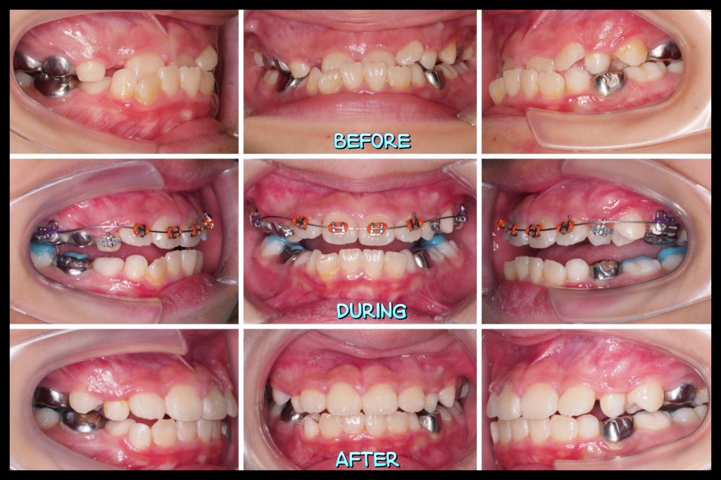 兒童前牙咬錯的早期矯正治療