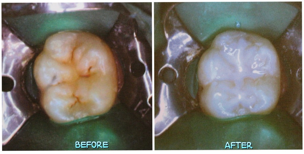 窩溝封填,Pit Fissure Sealant,在兒童牙科預防蛀牙的成效