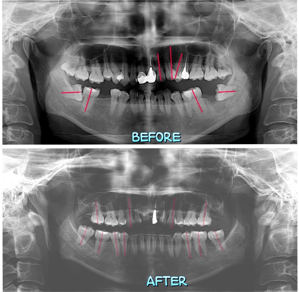 大臼齒扶正,molar uprighting