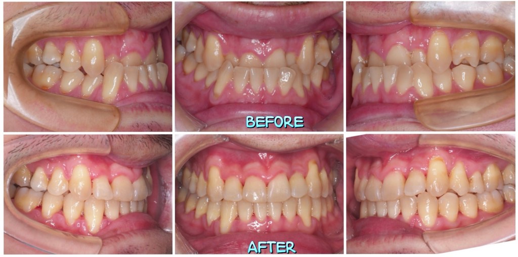 成人 三級咬合不正,Class III ,&nbsp;的齒顎矯正