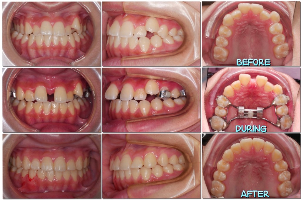 快速上顎擴張器,RPE