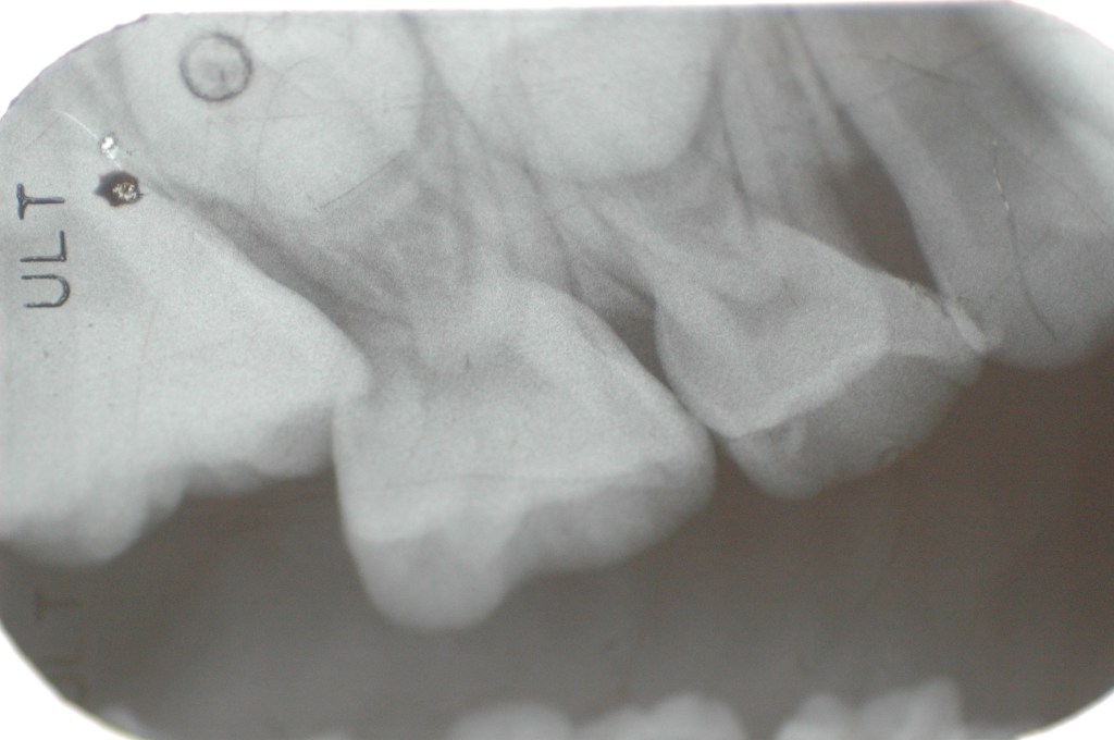 異位性萌發（Ectopic Eruption）